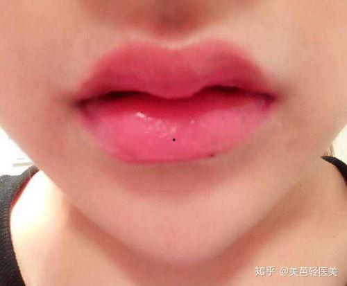 玻尿酸打嘟嘟唇视频,轻松拥有迷人唇形教程