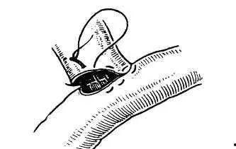 连续缝合法视频,轻松掌握高效缝合技巧